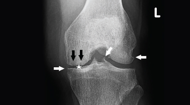 ​Figure 9. Osteoarthritis. Note the joint space narrowing in the medial compartment (white star), osteophytes (white arrows) and subchondral cysts (black arrows).