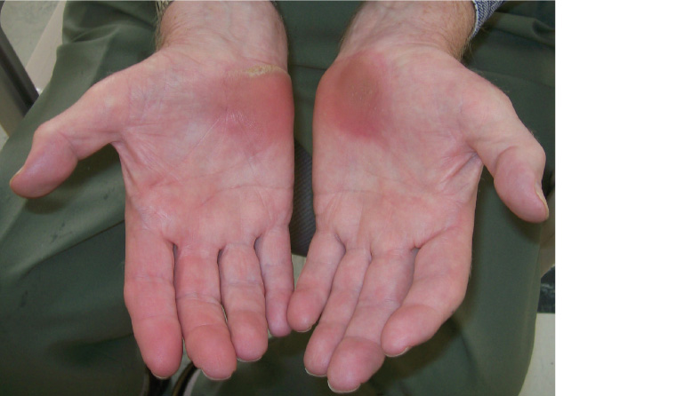 Figure 1. Pigmentation, callosity and atrophy on the ulnar side (hypothenar area) around the Guyon’s tunnel of the right hand and around the carpal tunnel on the left hand from excessive pressure during the use of the walking frame.