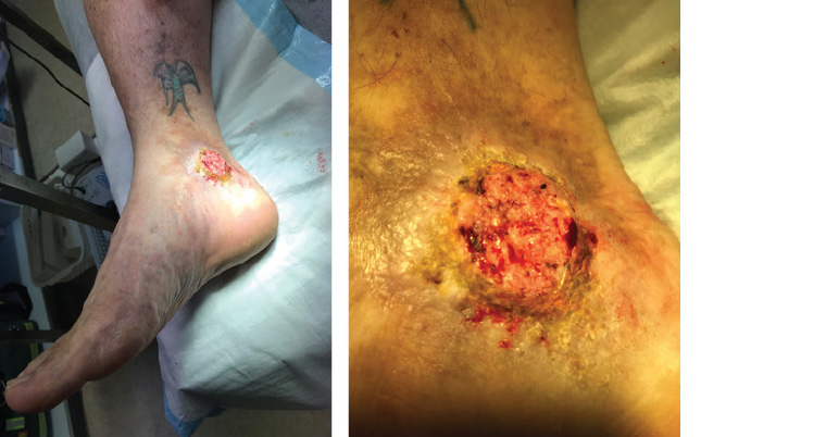 Figure 1. Skin growth on person's right medial ankle.
