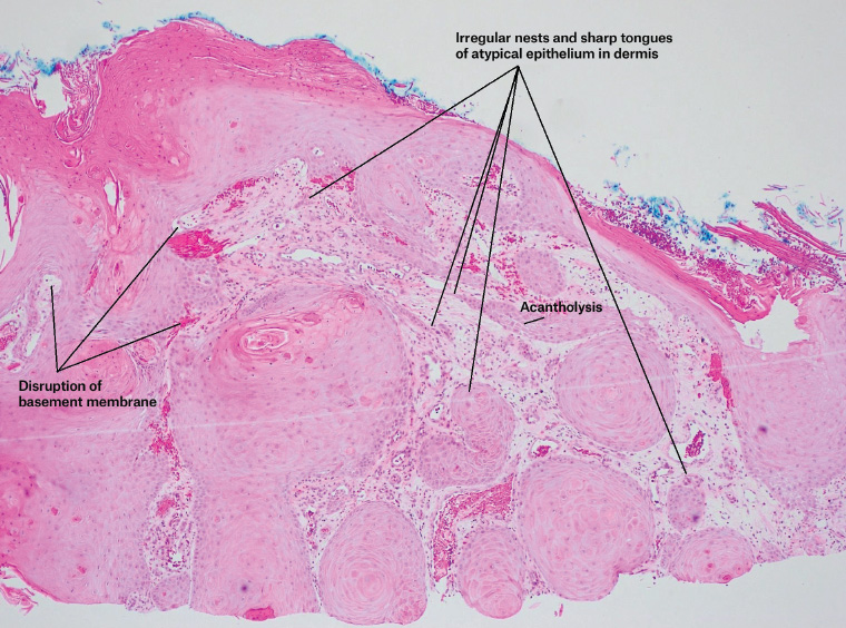 Figure 2. Superficial tissue fragments show a well-differentiated squamoproliferative lesion, suspicious for well-differentiated squamous cell carcinoma, arising within a background of severely solar-damaged skin with vascular changes associated with venous eczema.