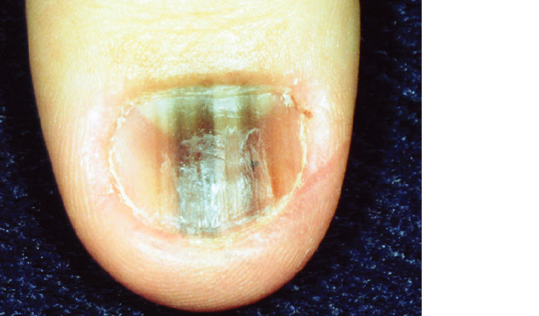 RACGP - Common skin conditions of the feet and nails