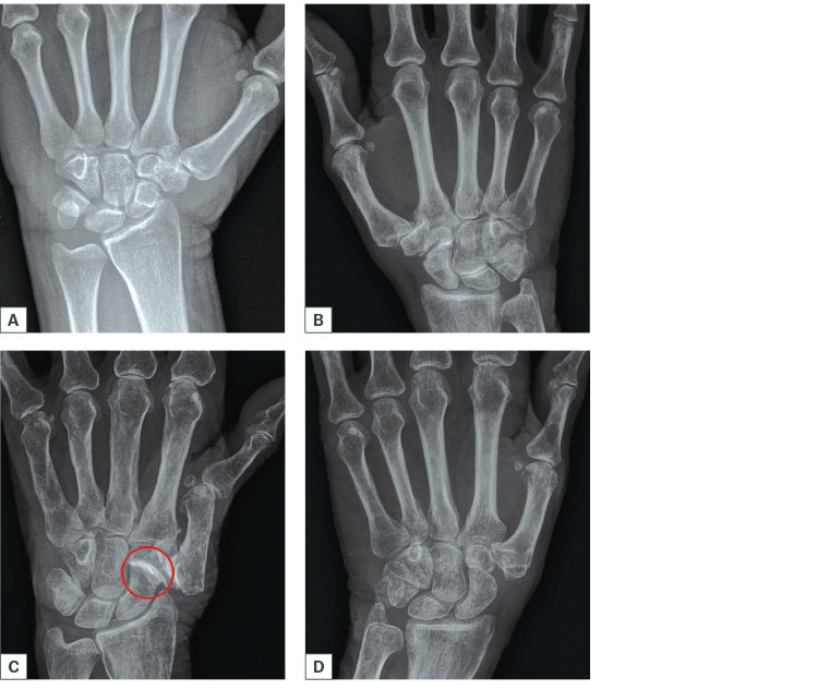 Figure 1. Different radiographic stages of basal thumb arthritis.