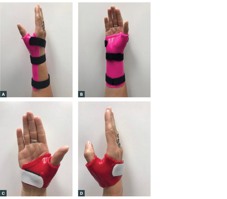 Figure 2. Examples of opponens splints that help support and position the thumb in a position of function within the hand.