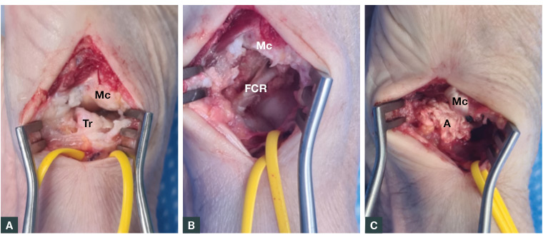 Figure 3. A. Arthritic thumb carpometacarpal joint (Mc – metacarpal; Tr – trapezium), vessel loop around radial artery; B. Post-trapeziectomy flexor carpi radialis in floor (Mc – metacarpal; FCR – flexor carpi radialis); C. Post–ligament reconstruction and tendon interposition (Mc – metacarpal with flexor carpi radialis sling; A – anchovy made from flexor carpi radialis tendon).