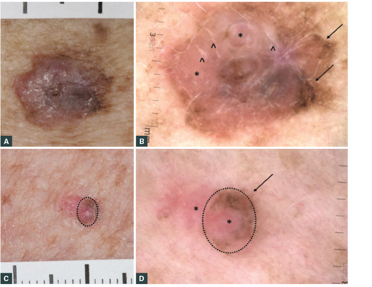 Figure 1. Two macroscopic and dermoscopic examples of superficial spreading melanomas (SSMs) showing asymmetry, border irregularity, colour variation, large diameter and elevation.