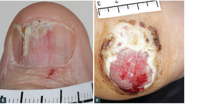 Figure 2. Examples of melanoma mimicking other more benign conditions.