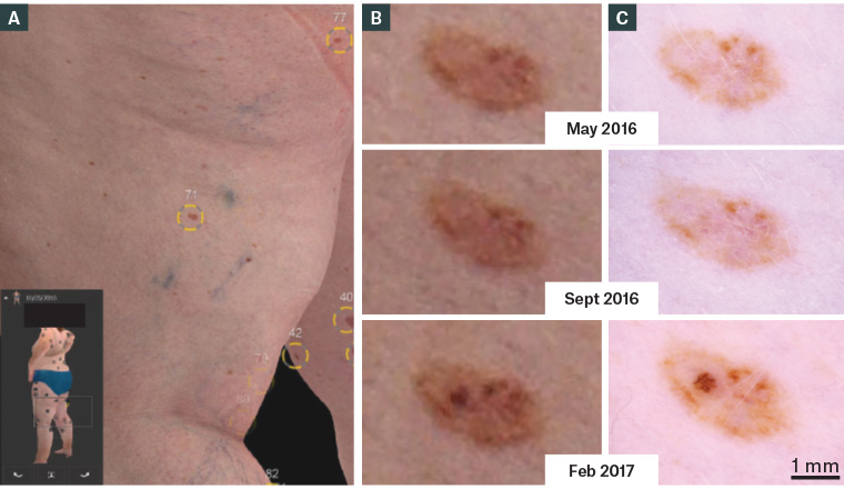 Figure 3. A. Three-dimensional total body photography; B. Digitally magnified three-dimensional image of a naevus evolving to melanoma in situ; C. Adjacent sequential dermoscopy.