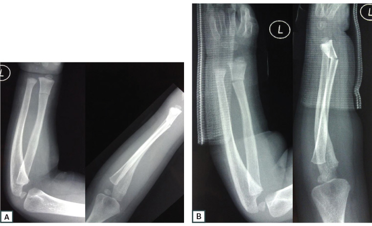 Figure 1. Anteroposterior and lateral X-rays of the forearm and wrist showing a greenstick fracture of the distal radius in a child aged three years.