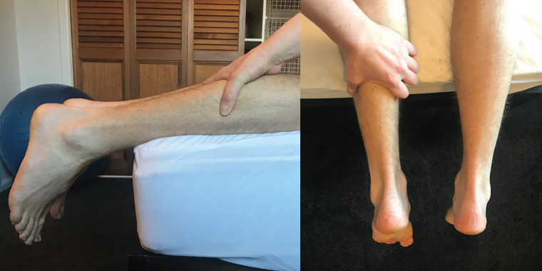 Figure 1. Demonstration of a negative Simmonds’ squeeze test (no rupture evident).
