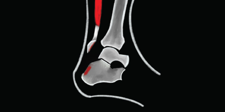 Figure 2. Calcaneal tuberosity fracture.