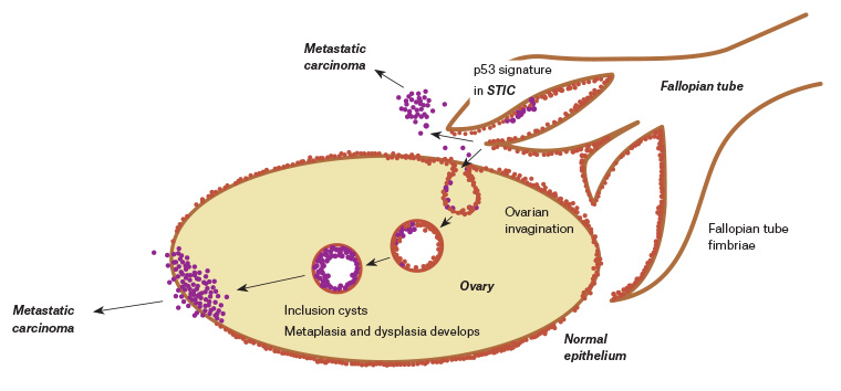 RACGP - Advances In Epithelial Ovarian Cancer