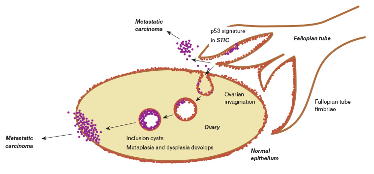 Figure 1. Aetiology of high-grade serous ovarian cancer