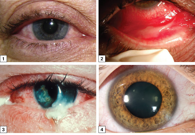 Figure 1. Adenoviral conjunctivitis. Figure 2. Viral conjunctivitis. Figure 3. Bacterial conjunctivitis. Figure 4. Circumciliary redness caused by dilated and congested perilimbal vessels in iritis