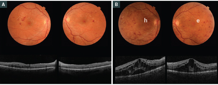 Figure 2. Fundus examination and optical coherence tomography imaging of a pregnant woman aged 22 years with type 2 diabetes A. At 15 weeks’ gestation (visual acuity 6/18); B. At 20 weeks’ gestation showing worsening of diabetic retinopathy and macular oedema in both eyes (visual acuity 6/36; h – retinal haemorrhage; e – retinal exudates).
