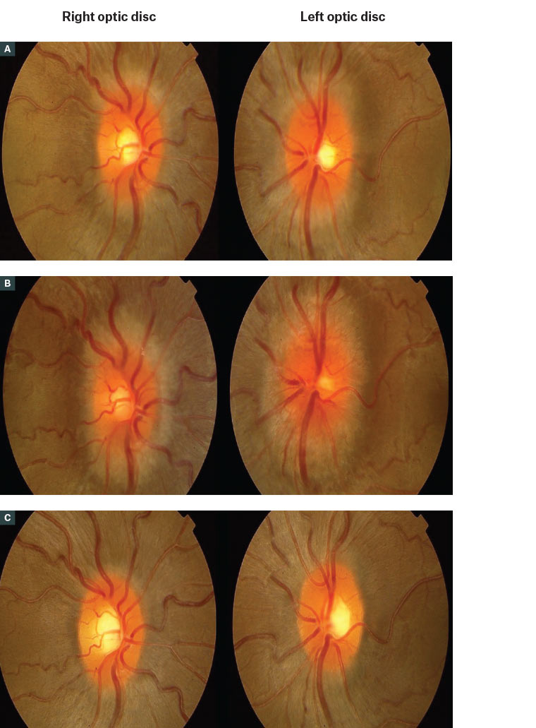 Figure 3. Serial fundus photographs of a patient with idiopathic intracranial hypertension.