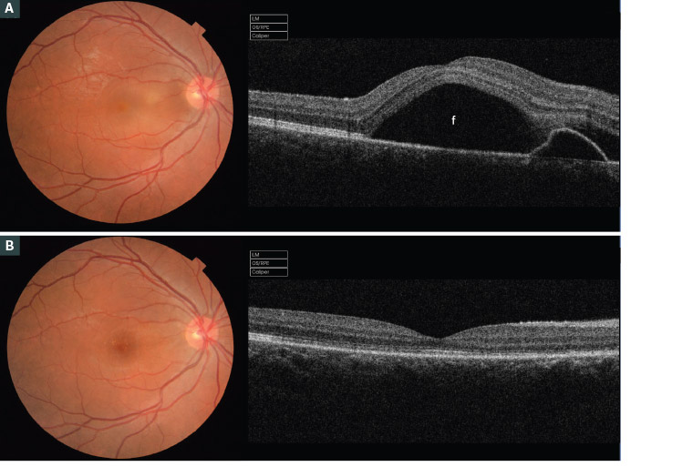 Figure 4. Fundus examination and optical coherence tomography imaging of a Caucasian woman aged 33 years during her second pregnancy A. In her fifth month of gestation, showing central serous chorioretinopathy in her right eye; b. Spontaneous resolution of the subretinal fluid in the postpartum period.
