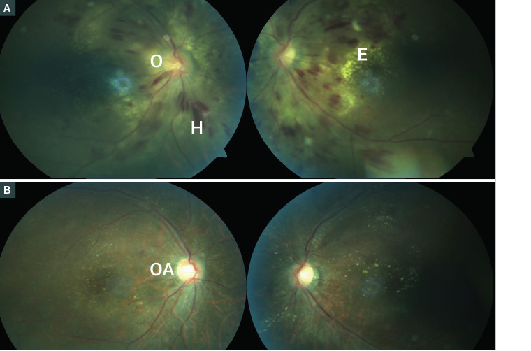 Figure 5. Coloured fundus photographs of a patient with pre-eclampsia  A.   Bilateral retinal haemorrhage with both flame-shaped and blot haemorrhage (H) and lipid exudate (E), especially around the left macula and bilateral optic nerve swelling (O); B. Postpartum; the blood pressure was controlled and the retinal changes improved after five weeks, but the patient had residual right optic atrophy (OA) showing pallor of the optic nerve and residual exudates.