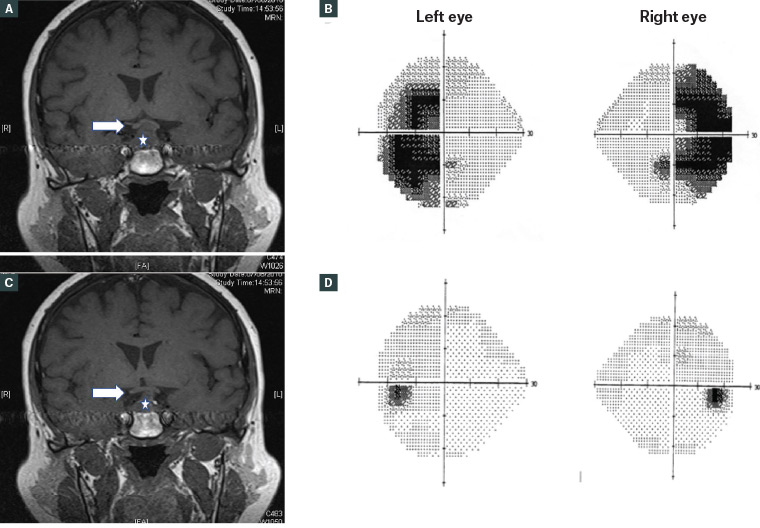 Figure 6. Coronal magnetic resonance imaging scan and visual field study of a patient with a pituitary adenoma during pregnancy  A. Pituitary adenoma (star) enlarged during pregnancy and abutting the optic chiasm from below (arrow); B. The resulting bitemporal hemianopia; c. Postpartum, the adenoma regressed in size and was not compressing the chiasma (arrow); d. The bitemporal hemianopia resolved postpartum.