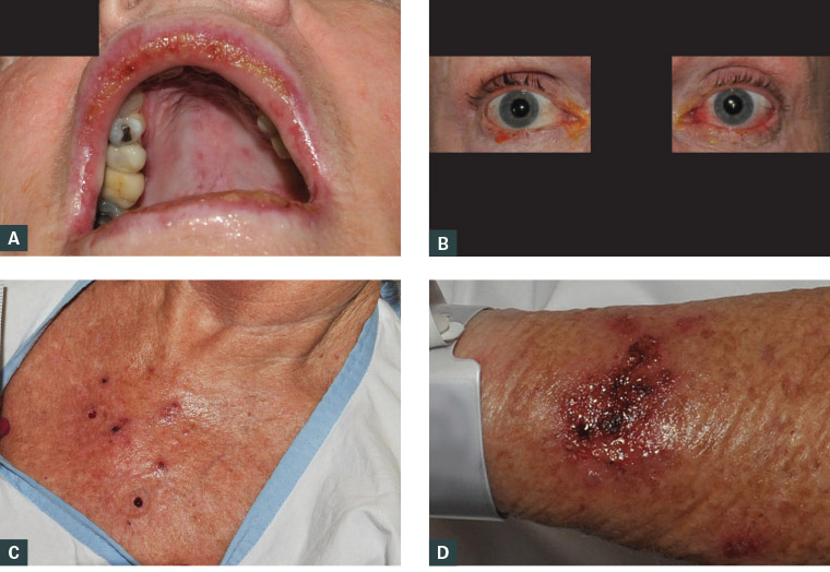Figure 1. Findings on patient examination  A. Oral mucosal ulceration; B. Conjunctivitis; C. Multiple blistering lesions on the central chest; D. Expected cutaneous reaction to topical imiquimod cream.