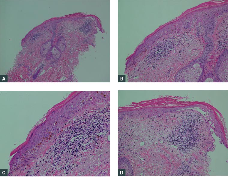 Figure 2. Sections of the punch biopsy, showing a dense lymphocytic infiltrate within the dermis with scattered neutrophils present  A. & B. Parakeratosis and apoptotic keratinocytes within the epidermis; C. Pigment incontinence; D. Subepidermal bulla formation.