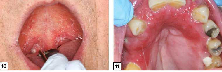 Figure 10. Oral pseudomembranous candidosis of the palate. Figure 11. Denture-associated erythematous stomatitis of the upper palate and alveolus with a papillary appearance anteriorly.