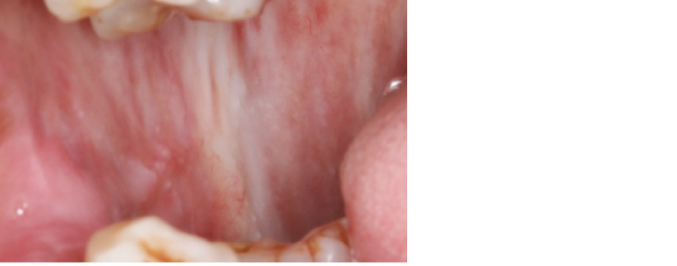 Figure 14. Oral submucous fibrosis associated with betel quid chewing.