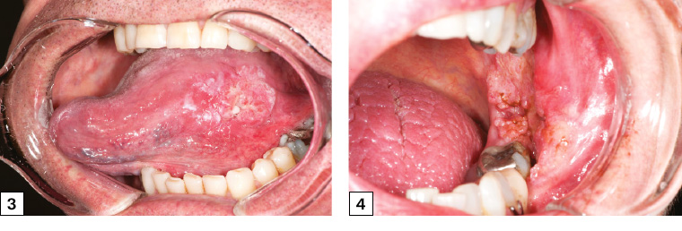 Figure 3. Left lateral tongue squamous cell carcinoma with irregular margins, heterogeneous appearance and raised, rolled edges. The cancer was palpably firm and indurated, unlike normal tongue tissue. Figure 4. Left buccal/retromolar trigone squamous cell carcinoma. The lesion had characteristic rolled edges with irregular margins and likely invasion of the posterior mandible, as the lower left molar was mobile. The lesion was initially attributed to cheek biting, which resulted in a delay in referral for several months.