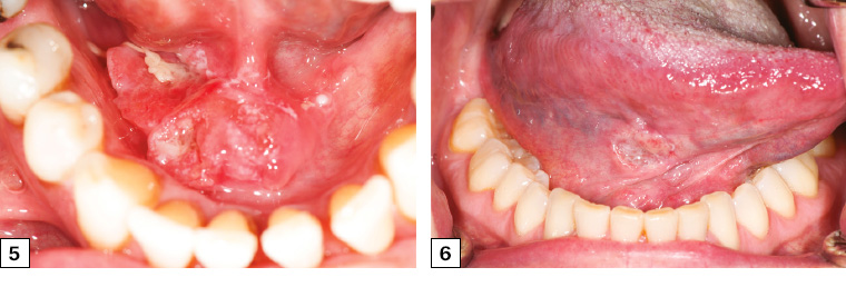 Figure 5. Right floor of mouth squamous cell carcinoma crossing the midline with heterogeneous appearance and irregular margins. Figure 6. Early-stage right tongue squamous cell carcinoma in a female patient who did not smoke who presented with a six-week history of a slightly sore right tongue and persistent ulcer.