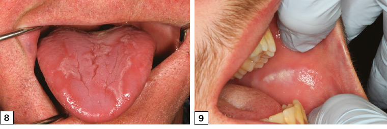 Figure 8. The alternating red atrophic areas surrounded by the white raised hyperkeratotic areas typical of geographic tongue. Figure 9. Linear frictional keratosis of the right buccal mucosa corresponding to the occlusal plane where the upper and lower dentition meet.