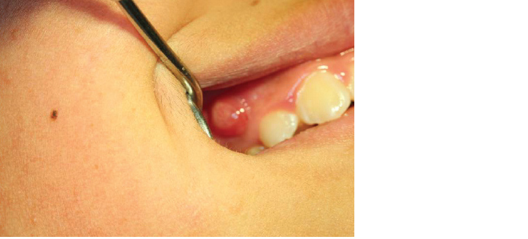 Figure 10. Draining sinus associated with a necrotic primary molar in a child aged nine years