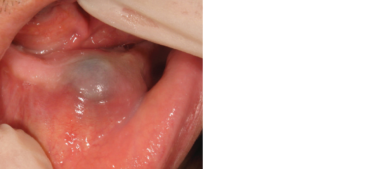 Figure 11. Swelling over the mandibular alveolus with normal-appearing mucosa.