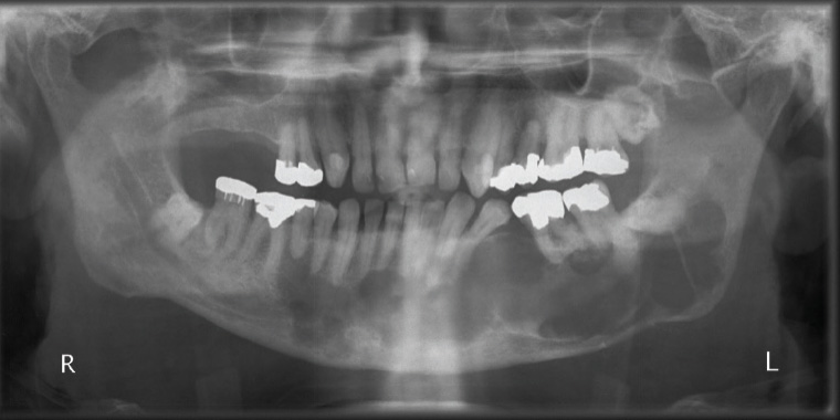 Figure 13. Orthopantomogram of an odontogenic keratocyst showing a well-corticated multilocular radiolucent lesion extending from the left ramus to the right body of the mandible, causing displacement of teeth and root resorption.