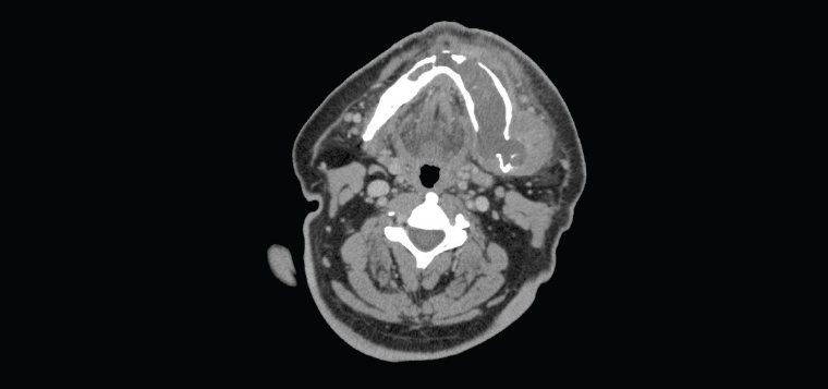 Figure 14. Axial computed tomography slice showing cortical expansion of the left mandible from the odontogenic keratocyst, with small areas of cortical breach