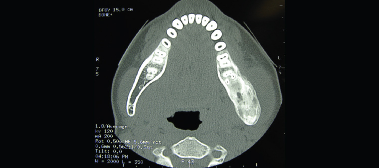 Figure 15. Axial computed tomography slice showing the mixed lucent–opaque lesion of fibrous dysplasia of the left posterior mandible