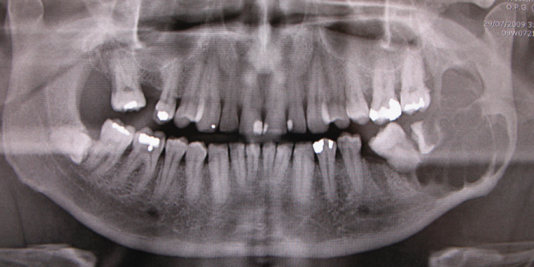 Figure 16. Orthopantomogram showing a multilocular radiolucency present in the left ramus/angle of the mandible associated with root resorption of the lower left third molar. The patient presented with left jaw swelling, and biopsy revealed solid/multicystic ameloblastoma. This required segmental resection of the mandible and free flap reconstruction.