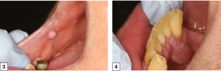 Figure 3. Fibroepithelial polyp on the right post-commissural region of the buccal mucosa with normal overlying mucosa. Figure 4. Pyogenic granuloma arising from the attached lingual gingiva of the lower right canine