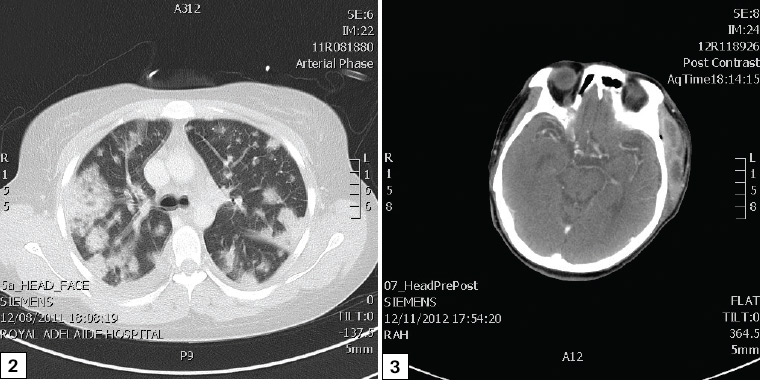 Figure 2. Mediastinal and lung involvement from a spreading odontogenic infection. Figure 3. Cerebral mycotic aneurysm and cavernous sinus thrombosis from a spreading odontogenic infection.