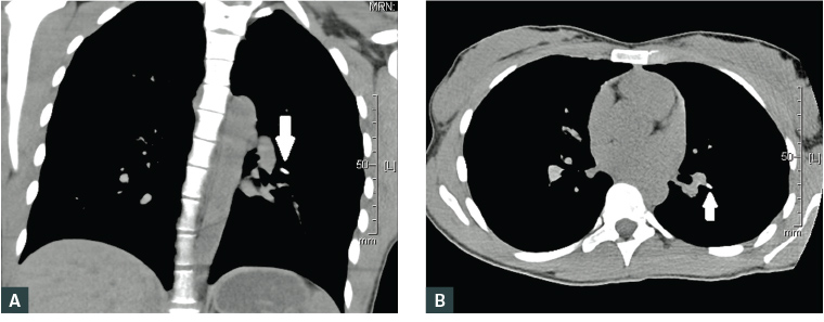 Figure 1. Non-contrast computed tomography lung reformats showing pulmonary embolisation of Implanon NXT device (arrow), with the proximal end in the pulmonary artery and the distal end within the lung parenchyma.