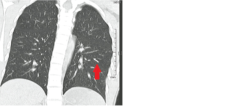 Figure 2. Coronal non-contrast computed tomography lung reformat showing embolised device (arrow) and normal lung distal to this.
