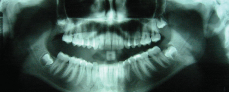 Figure 15. Orthopantomogram showing bilateral fracture of the mandible seen at the left angle and right parasymphysis.