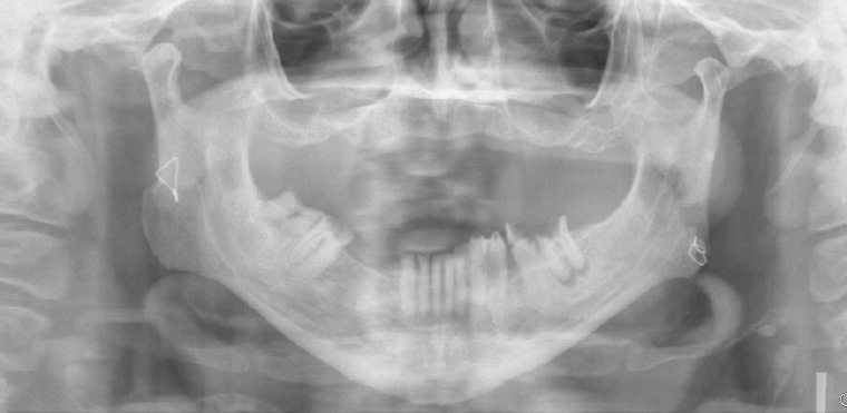 Figure 17. Orthopantomogram showing bilateral mandibular dislocations.