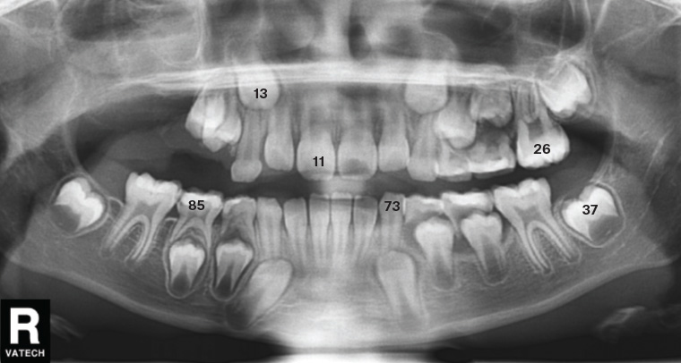 Figure 4. Orthopantomogram showing tooth numbering of both permanent and deciduous teeth.