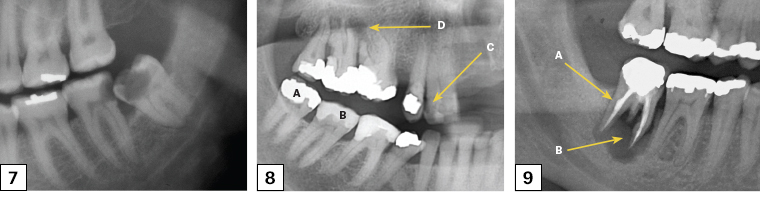 Figure 7. Left segment of an orthopantomogram showing decay in the lower left third molar (38) and the distal of lower left second molar (37). Figure 8. Right segment of an orthopantomogram of teeth with dental work in place. A. Metallic restoration; B. Tooth-coloured restoration; C. Decay; D. Abscess. Figure 9. Right segment of an orthopantomogram showing odontogenic bone pathology A. Root canal treated tooth; b. Large dental abscess.