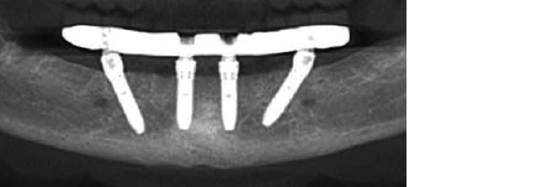 Figure 2. Standard mandibular ‘all-on-4’ implants.