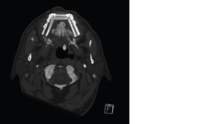 Figure 4. Osteotomies of a fibula free flap to reconstruct a maxilla.