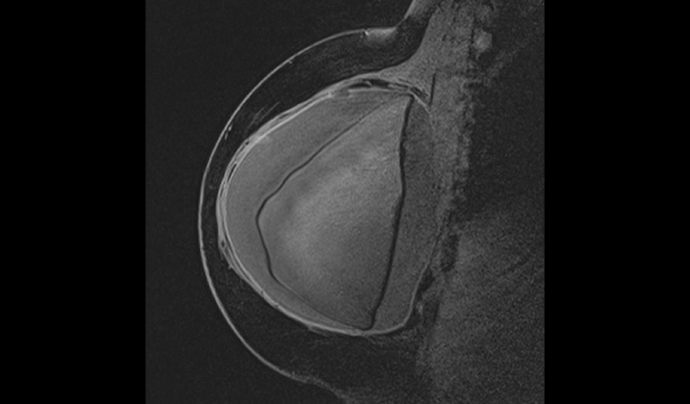 Figure 3. Sagittal magnetic resonance imaging of the right reconstructed breast