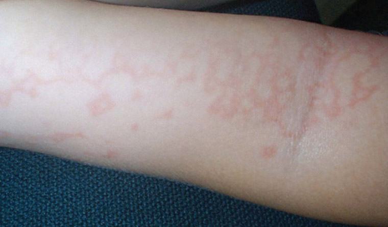 Figure 2. Lacy reticular erythema showing a net-like pattern on the arm of a child with erythema infectiosum