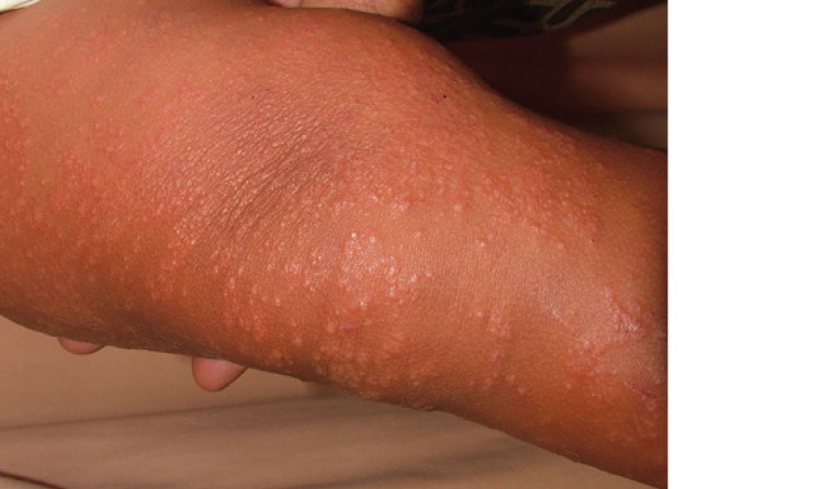 Figure 3. Gianotti-Crosti syndrome presenting as a papulovesicular eruption affecting the extensor surface of the arm