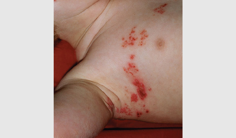 Figure 7. Clusters of vesicles on an erythematous base localised to a dermatome in shingles