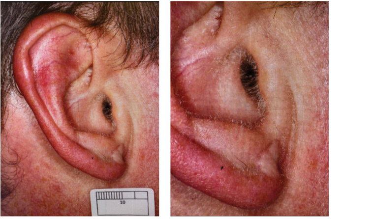 Figure 1. Skin graft scar of right ear lobe